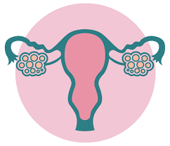 PCOS polycystic ovary syndrome