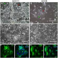 Le 19 avril, pris de court par la deuxième vague, le gouvernement du nationaliste hindou narendra modi a décidé de l'étendre aux plus de 18 ans. A Multiplex Preclinical Model For Adenoid Cystic Carcinoma Of The Salivary Gland Identifies Regorafenib As A Potential Therapeutic Drug Scientific Reports