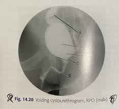 Image result for Voiding Cystourethrogram