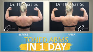 Arm Liposuction Immediate Results Toned Arms Lipo 360 Arms Celebr In 2020 Liposuction Arm Liposuction Toned Arms