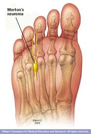 Morton S Neuroma Mayo Clinic Morton S Neuroma Neuroma Neuroma Surgery