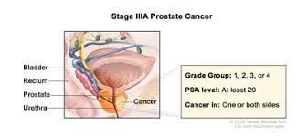 Prostate cancer occurs when cells in the tissue of the prostate gland become abnormal and grow out of control. Prostate Cancer Treatment Pdq Treatment Patient Information Nci Michigan Medicine