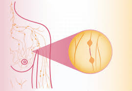 Image result for Inflammatory breast cancer