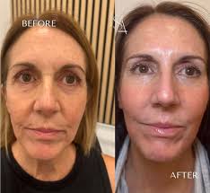 The Power of CO2 ✨ Brighter skin ✔️ Pigmentation ✔️ Even skin tone ✔️  Under-eye wrinkles/bags ✔️ Skin elasticity ✔️ 💫 Reveal smoother, tighter,  more radiant skin with our advanced CO2 laser.