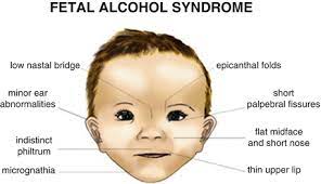 Fetal Alcohol Spectrum Disorders Academic And Psychosocial Outcomes Springerlink