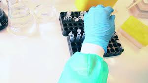 Albumine, aproape 2/3 din totalul proteinelor serice. Electroforeza Proteinelor Serice Youtube