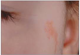 It consists of overgrown epidermis (upper layers of the skin), sebaceous glands, hair follicles, apocrine glands and connective tissue. Does This Yellow Brown Plaque On A Young Girl S Cheek Require Removal Consultant360