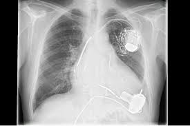 Pacemaker and defibrillator recall information including mode of failure, model numbers, and manufacturer recommendations on implantable defibrillators and pacemakers made by medtronic. Medical Mystery What Caused Chest Pain Shortness Of Breath In Older Man