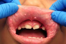 Image result for Labial mucosa