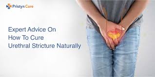This helps ease pain, fight the infection and reduce your risk of passing the infection along to others. Expert Advice On How To Cure Urethral Stricture Naturally Pristyn Care