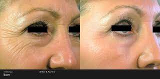 Check spelling or type a new query. Laser Skin Resurfacing Anna Avaliani Md Cosmetic Laser Surgery Anna Avaliani Md Cosmetic Laser Surgery