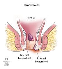 Image result for Hemorrhoid