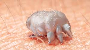 Image result for scabies on humans