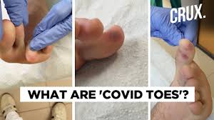 In addition to the main symptoms, people around the world have reported experiencing various other side effects that they believe could be linked to the virus, including covid toe and rashes on other. Covid Toes Seen In Asymptomatic Patients Of Coronavirus Youtube