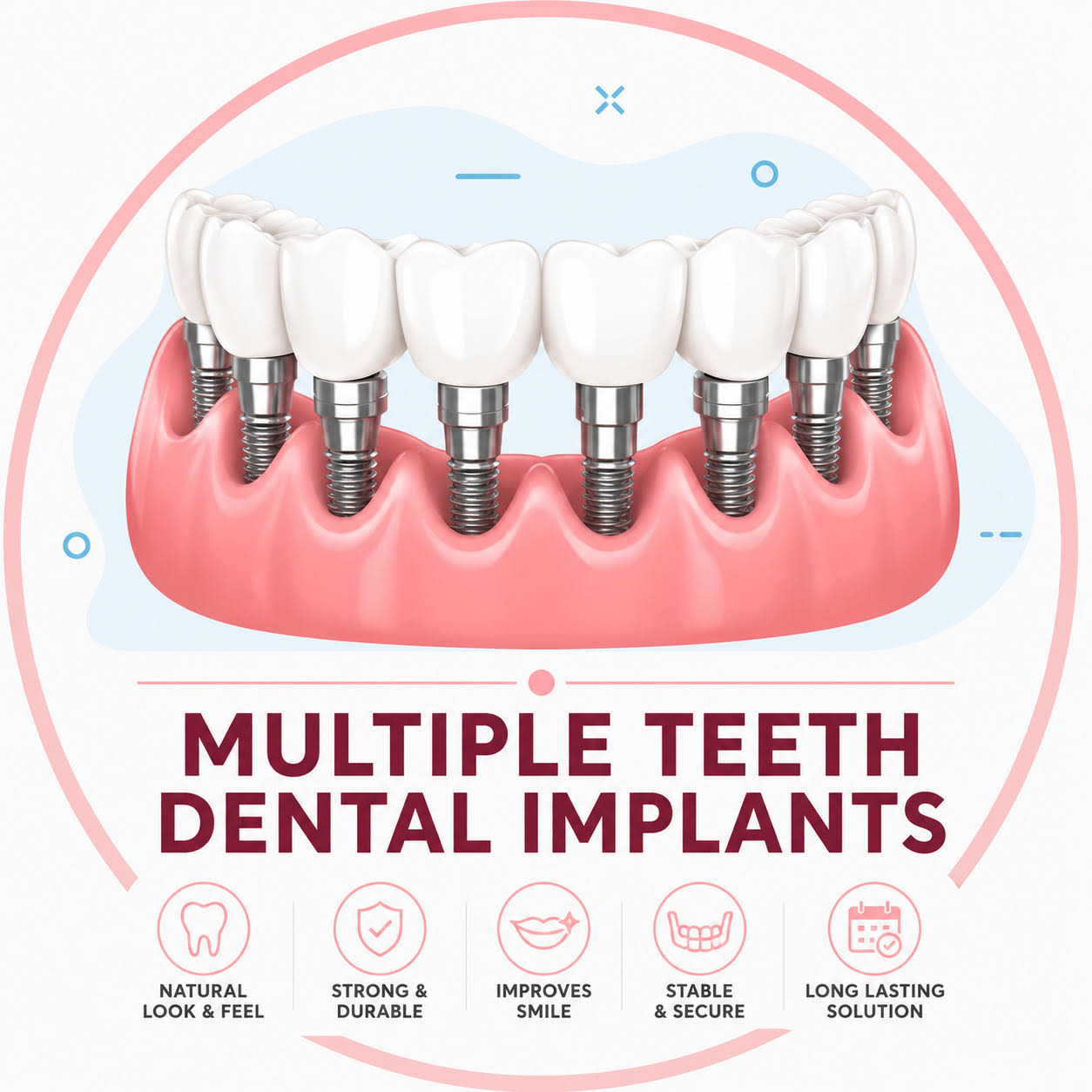 Multiple teeth Replacement with Dental Implants
