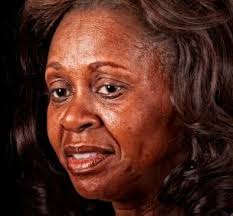 Hyperpigmentation is a common skin condition. African American Skin Discolorations Lovetoknow