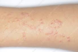 Very severe reactions could lead to additional swelling. Allergic Reaction To Henna Tattoo Stock Image C026 3301 Science Photo Library