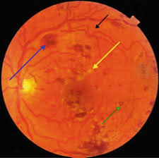 Image result for Hyperviscosity Syndrome