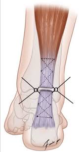 With aging and overuse, the achilles tendon is subject to degeneration within the substance of the tendon. Diagrammatic Drawing Of The Achilles Tendon Sutured Using Open Repair Download Scientific Diagram