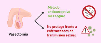 Es una intervención simple que se realiza bajo anestesia local y no requiere hospitalización. Que Es El Seminograma De Control Despues De La Vasectomia
