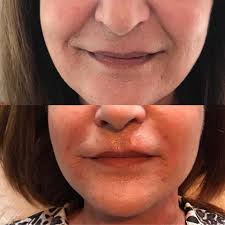 🍀 Plasma-Gel BioFiller