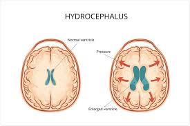 Image result for Hydrocephalus