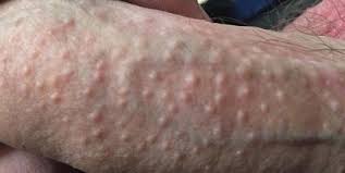 Therefore, you should know more about the causes before adopting any measures of treatment or removal. Fordyce Spots Shaft Of Penis Wolverhampton Worcester Gloucester Uk