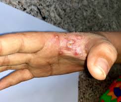 Pada video kali ini saya akan kongsikan penyakit yang agak common juga di kalangan kita iaitu kudis buta, atau dalam english. Anak Mengadu Gatal Naik Bintik Merah Ingatkan Ruam Rupanya Kudis Buta Pa Ma