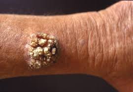 a dermatologist should examine all actinic keratosis. Warts American Skin Association