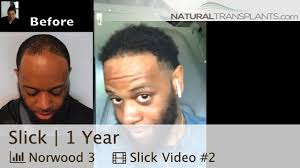 Pure unrefined oils for thickening hair, eyelashes, eyebrows. Hair Transplant Results Black Man At One Year By Natural Transplants Sl Hair Transplant Results Hair Transplant Afro Hair Transplant