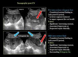 Check spelling or type a new query. Normal Vs Abnormal Post Operative Sonography Post Cs If Infection Like Endometritis Or Parametritis Parametrium Connective Tissue Adjacent To The Uterus