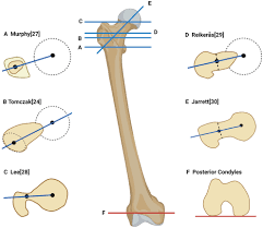 Image result for Femoral Retroversion