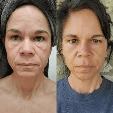 0.5mm Dermaroller (Real Individual Needles®)