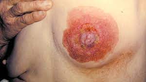 With my fibroadenomas, i felt more reassured because if you google 'breast lump', it lists many possible causes. Breast Cancer Dimpling Tips For Identification