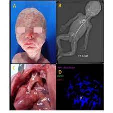 Pdf Truncus Arteriosus Communis Report Of Three Cases And Review Of Literature