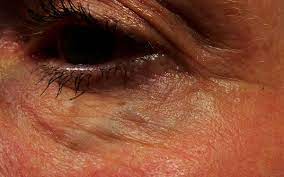 I have a dane on my right eye that in. Blue Veins Under Eyes Really Bother People