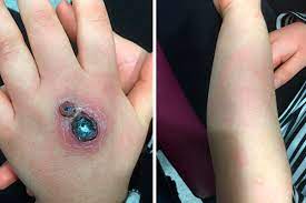 Acidentes com aranhas marrons são bem comuns. Menina De 8 Anos De Idade Enfrenta Cirurgia E Noites No Hospital Apos Picada De Aranha Marrom Veja Sao Paulo