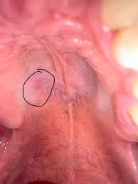 Image result for Mouth ulcers symptoms roof of the mouth
