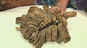 Image result for Tree man syndrome disorder