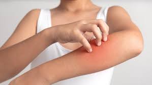 Hanya dengan obat gatal tradisional kunyit, gatal di tubuh dan alergi dijamin sembuh dalam waktu singkat, caranya mudah. Atasi Kulit Gatal Dengan Vitamin D Apakah Efektif