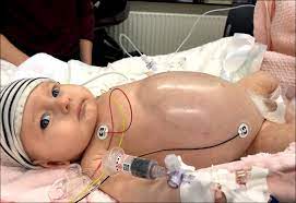 Syphilis has three stages, so it is important to determine the state you are in. Congenital Syphilis The Great Imitator Case Report And Review The Lancet Infectious Diseases