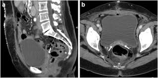 We did not find results for: Multidetector Ct Of Expected Findings And Complications After Hysterectomy Insights Into Imaging Full Text