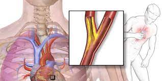 Nyeri dada berkembang ketika jantung bekerja lebih keras, seperti saat berolahraga atau menaiki tangga. Penyakit Angin Duduk Info Seputar Nyeri Dada Deherba Com