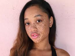 Comment soigner les taches pigmentaires sur les peaux noires et métisses ? Moquee Pour Ses Taches De Rousseur Une Jeune Americaine Devient Mannequin Biba Magazine