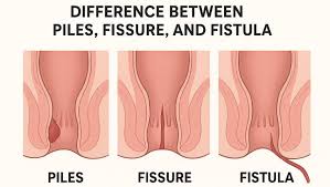 Medical illustration comparing piles, fissure, and fistula in the anal canal