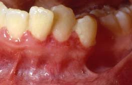Image result for granuloma gum disease