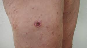 An eschar that goes completely around the chest can make it difficult to breathe. Eschar Causes Diagnosis And Treatment