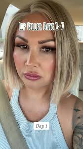 Llenado de labios: seguimiento los primeros 7 días