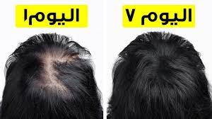 تحو ل شعري من خفيف إلى كثيف في أسبوع واحد youtube