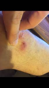 To use it, soak a gauze in vinegar then apply on the affected sport on the breast. Ingrown Hair Ingrown Nipple Hair Bump
